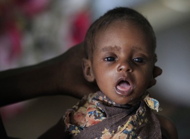 Two-month-old Fulhado Daud Aliyow rests in his mother's hand at a hospital where he is being treated for malnutrition in Dagahaley Camp, outside Dadaab, Kenya on Friday.