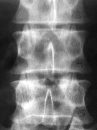 File photo of a spinal x-ray