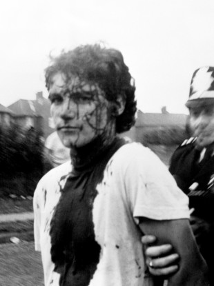 An injured picketer in Yorkshire in August, 1984