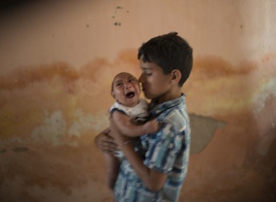 A two-month-old child in Brazil born with microcephaly