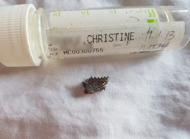 Christine had two surgeries to remove parts of the mesh device and another operate to successfully treat her stress urinary incontinence.