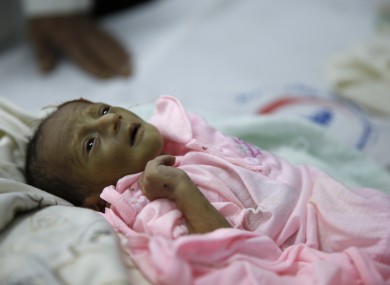 A malnourished child lies in a bed at a therapeutic feeding centre in a hospital in Sanaa, Yemen.