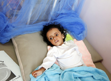 A famine-suffered child lies on a bed as he receives treatment at al-Sabaeen hospital in Sanaa, Yemen